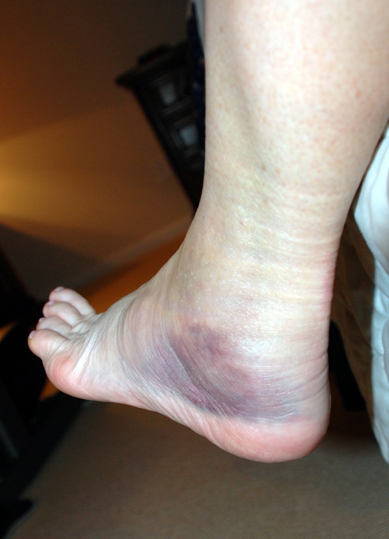 2009-02-08-02 SPRAINED ANKLE.jpg
